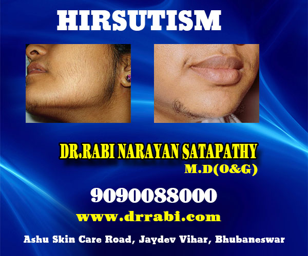 best hirsutism treatment clinic in bhubaneswar not far from kar hospital - dr rabi